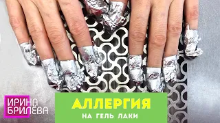 АЛЛЕРГИЯ на гель лаки 💅 Химический ОЖОГ НОГТЕЙ 💅 Онихолизис 💅 Ирина Брилёва