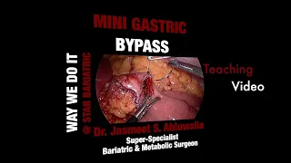 Mini Gastric Bypass Tutorial | Learn MGB | Master Video | Dr Jasmeet Singh Ahluwalia | Star Hospital