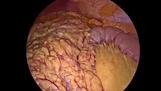 laparoscopic roux-n y gastroenterostomy