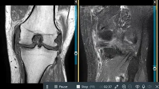 Knee pain after motorcycle accident