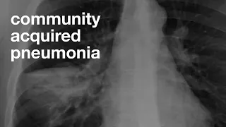 Community Acquired Pneumonia