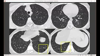 Holy Holes! Cystic Lung Disease on HRCT