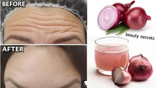 1 onion is a million times stronger than Botox, it eliminates wrinkles and fine lines instantly