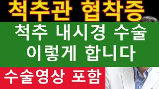 협착증 - 척추 내시경 수술 이렇게 합니다 - 수술 영상 포함