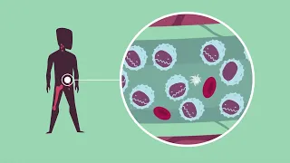 CLL - Qu’est-ce que la leucémie lymphoïde chronique ?