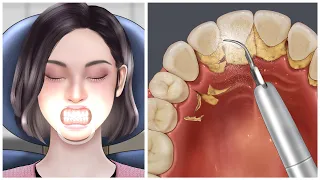 [ASMR] tartar removal animation / teeth scaling