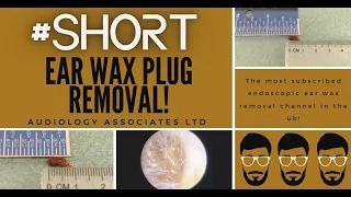 EAR WAX PLUG REMOVAL #SHORT