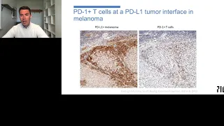 Primary and Acquired Resistance to Cancer Immunotherapy