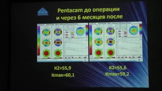 Фемтокросслинкинг. Опыт применения. Результаты