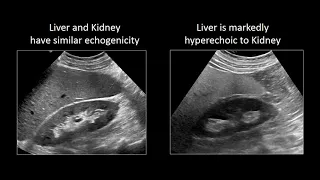 GI Imaging - Hepatic Steatosis and Cirrhosis