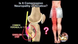 Is It Compression Neuropathy or Sciatica - Everything You Need To Know - Dr. Nabil Ebraheim