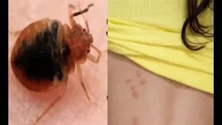 Do You Have Bed Bug Bites? 5 Bed Bug Bite Symptoms to Check for