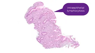 Lymphocytic gastritis