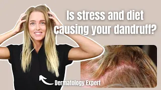 Root Cause of Seborrheic Dermatitis and How to Treat it Naturally