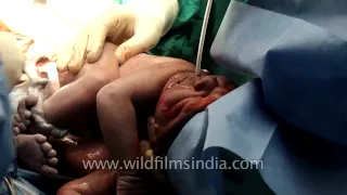 Magical moment of birth: A human baby is born!