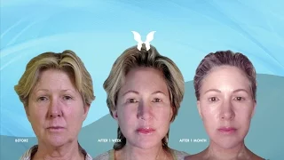Wave Facelift Patient - Looks and Feels 20 Years Younger!