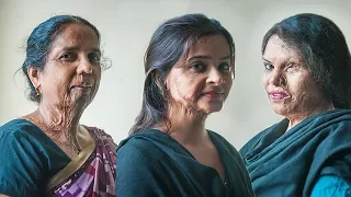 Make Love Not Scars: Acid Attack Survivors Get A Second Chance