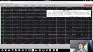 EEG of 52 Year Old With Episodes of Passing Out