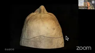 Essential surgical anatomy aspects in management of anterior and middle cranial base meningiomas