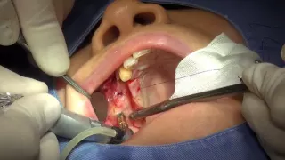 Dr Kwang Bum Park Implant Surgery #14, 16, 17, 35, 37 with AnyRidge