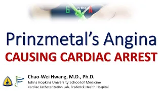 Prinzmetal's Angina causing Cardiac Arrest