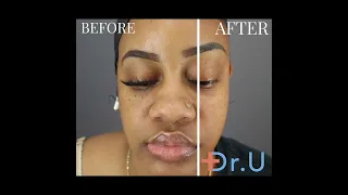 Moles aka DPN Removal Result