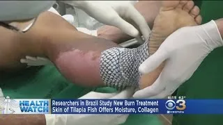 Researchers Experiment With Fish Skin Treatment For Burn Victims