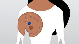 How Do Doctors Diagnose and Treat Breast Cancer?