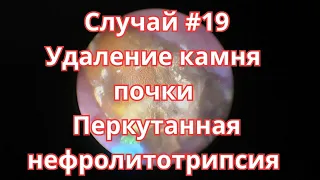 Случай #19. Удаление камня почки. Перкутанная нефролитотрипсия.