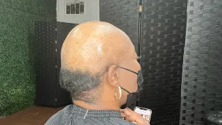 One of my subscribers flew in for an Alopecia Transformation.
