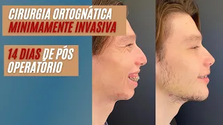 Recuperação em 7 dias- CIRURGIA ORTOGNÁTICA MINIMAMENTE INVASIVA