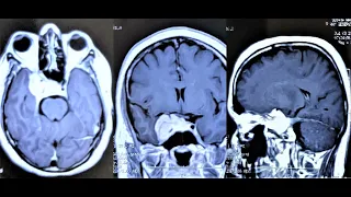 CAVERNOUS SINUS MENINGIOMA -MICROSURGERY-dr suresh dugani/HUBBALLI/KARNATAKA/INDIA