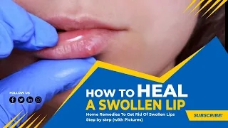 5 Methods That Can Help to Reduce Swollen Lip Fast at Home