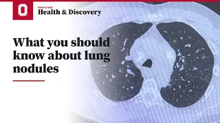 What you should know about lung nodules | Ohio State Medical Center