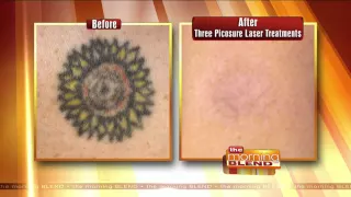 Removing Tattoos Quickly & Effectively