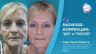 "ДО" и "ПОСЛЕ", коррекция с Radiesse