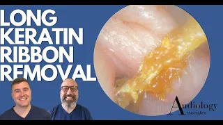 LONG KERATIN RIBBON REMOVAL - EP881