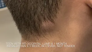 Lump in Back of Head for 1 month in 16 y.o. Boy
