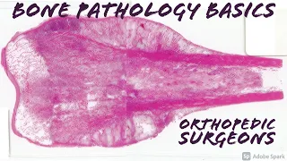 Bone Tumor Pathology Basics (Medical Students, Orthopedic Surgery, USMLE, Board Review)