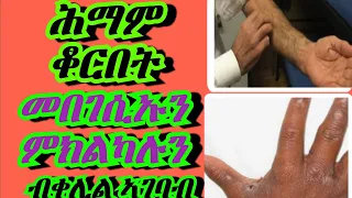 ሕማም ቆርበት ብቀሊሉ ንምክልካል