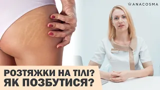 РОЗТЯЖКИ НА ТІЛІ, СТРІЇ 😭 ЯК ПОЗБУТИСЯ⁉️