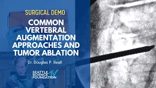 Common Vertebral Augmentation Approaches and Tumor Ablation - Douglas P. Beall M.D.