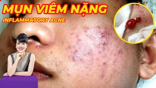 Điều trị mụn viêm hiệu quả tại TPHCM | Hiền Vân spa | Inflammatory Acne treatment |Đỗ Thu Hiền | 664