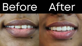 Smile makeover in chennai / Porcelain Veneers / Ceramic veneers / Smile design/Smile Story 9