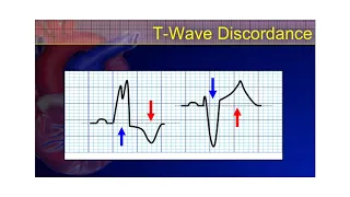 The 12-Lead ECG Course - STE-Mimics Part 2