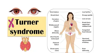 Turner Syndrome - Causes, Clinical Features, Diagnosis & Evaluation