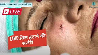 Live Mole Removal Surgery | Best Mole removal treatment in Delhi @SkinQure | Dr. Jangid