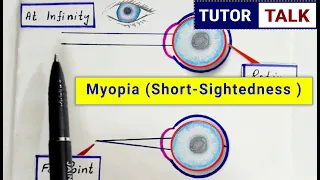 What is Myopia | Short Sightedness  | Defects of eye class 10  | Causes | Correction