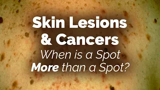 When is a Spot More than a Spot? Skin Lesions and Cancers