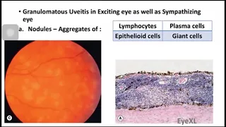 Sympathetic Ophthalmitis